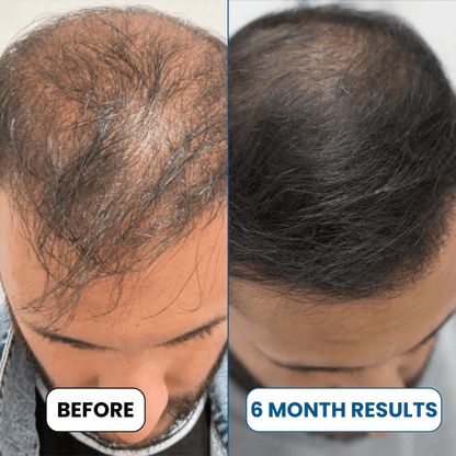 Alurisio® Advanced Hair Density Roll On Serum - 23% Hair Growth Actives