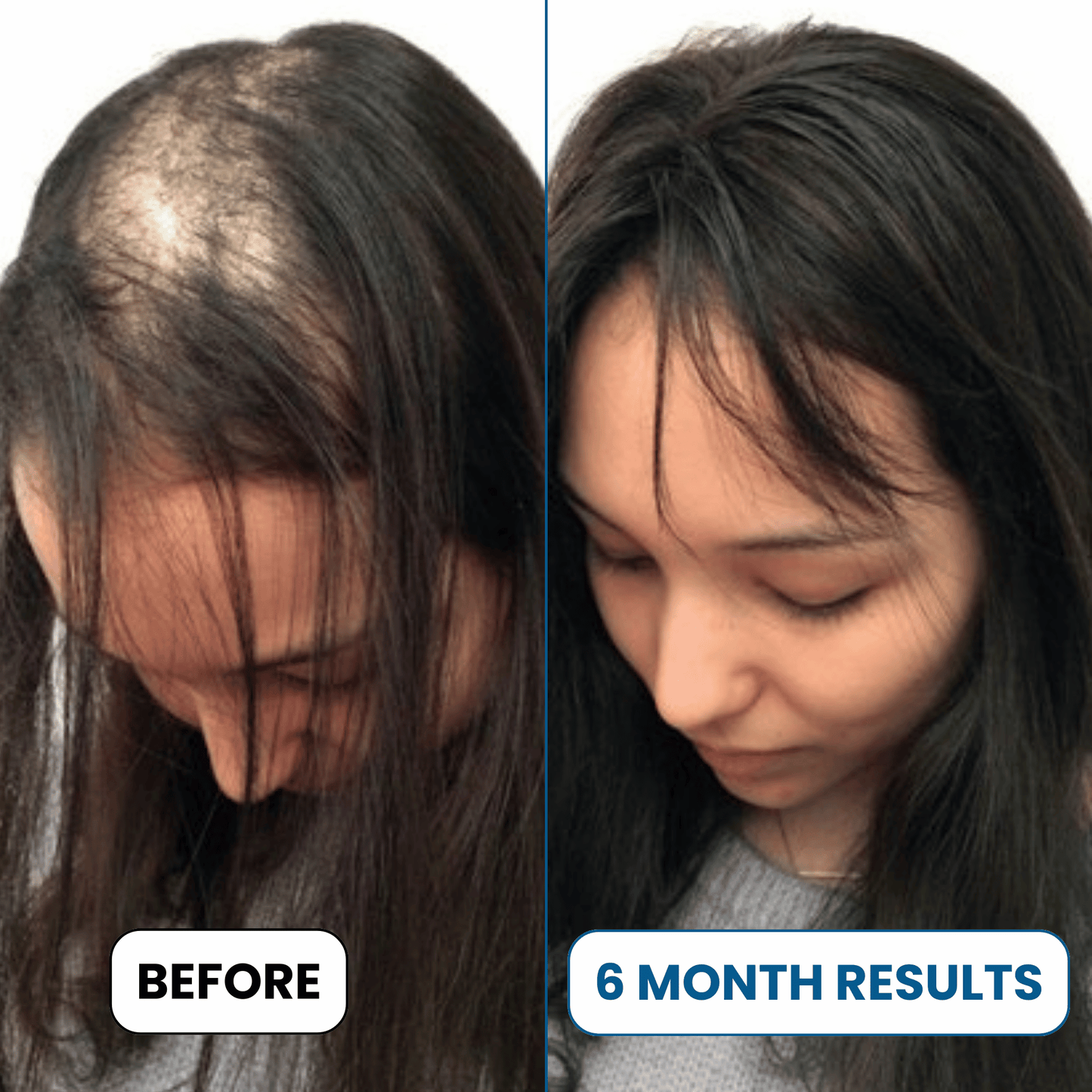 Alurisio® Advanced Hair Density Roll On Serum - 23% Hair Growth Actives