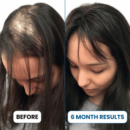 Alurisio® Advanced Hair Density Roll On Serum - 23% Hair Growth Actives
